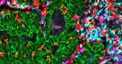 Tumor Cell Heterogeneity & Immune Response image